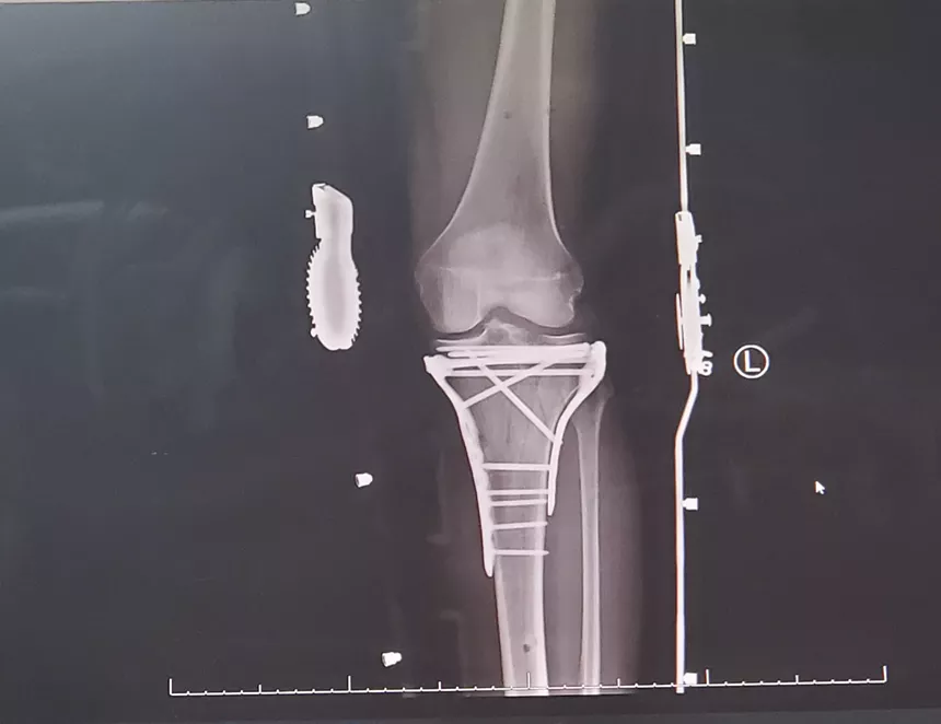 An X-ray image of the screws and plates in Anthony Penta's leg - PHOTO COURTESY OF ANTHONY PENTA