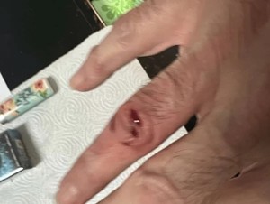 Mario Tabraue's bloody wound on his finger